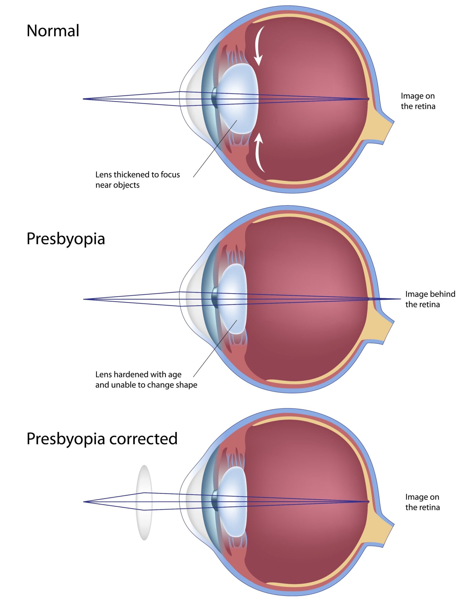 Premium Lens Implants Franklin | Specialty Intraocular Lenses Brookfield